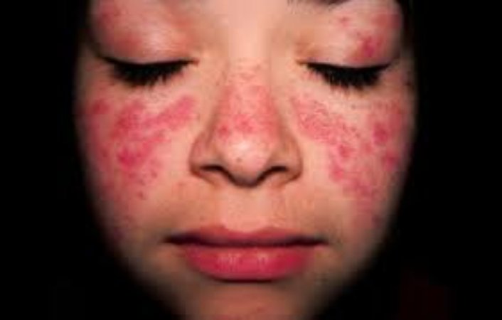 Lupus/sistemik lupus eritematosus