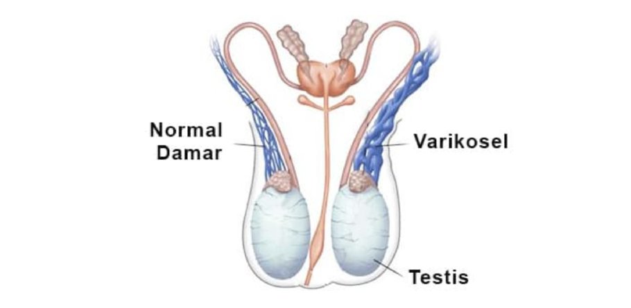 Varikosel nedir
