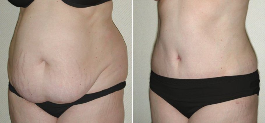 Qarın gərmə - mini abdominoplastika, tam abdominoplastika, full abdominoplastika body plastika