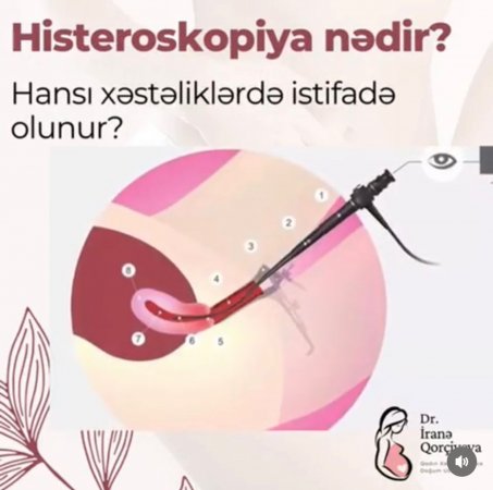 Histeroskopiya nədir?