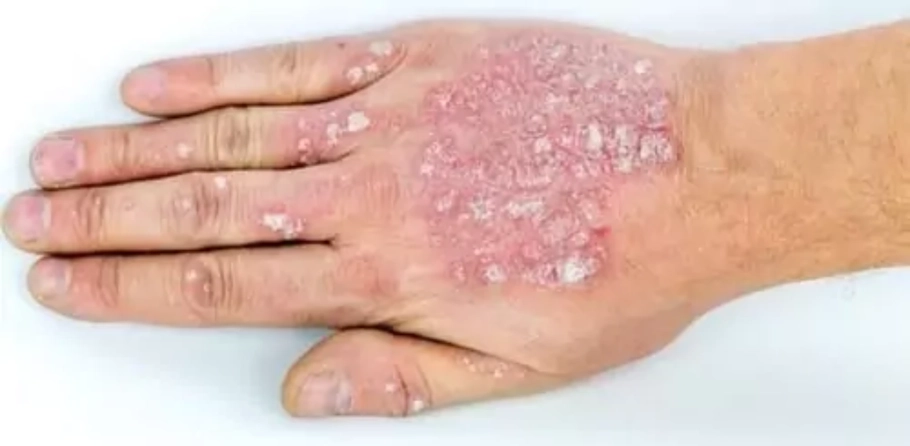Pullu dəmrov (psoriaz) haqqında