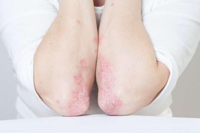 Lupus / sistemik lupus eritematosus