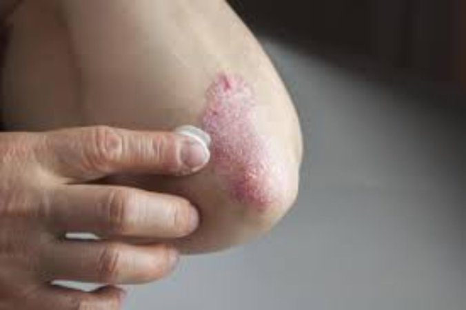Psoriaz (dəmrov)