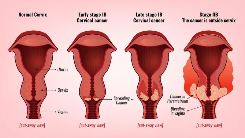 Uterus xərçəngi: səbəbləri, simptomları və müalicəsi