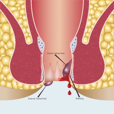 Hemoroid nədir?