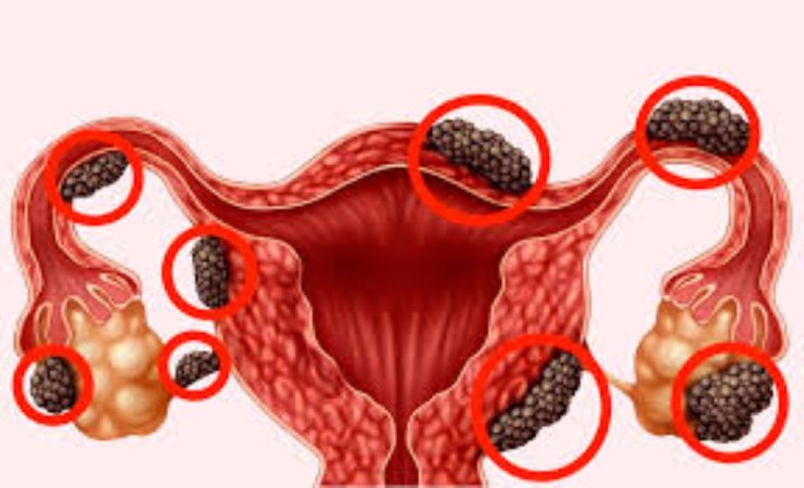 Endometrioz