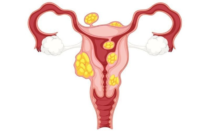 Iltihabi xəstəliklər (endometrit, salpingit, ooforit, kolpit ( vaginit), servisit, bartolinit, vulvit)