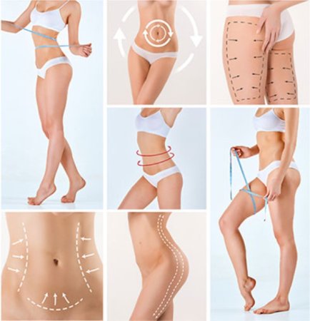 Lipoedema cərrahiyyəsi: ağrısız və estetik qadın sağlamlığı