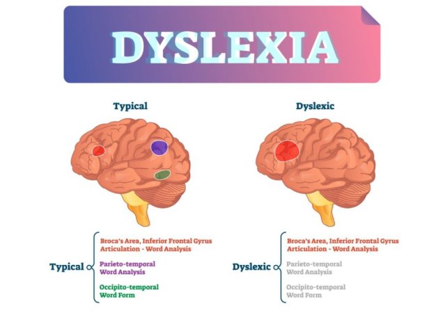 Disleksiya növləri, Əlamətləri və müalicə üsulları