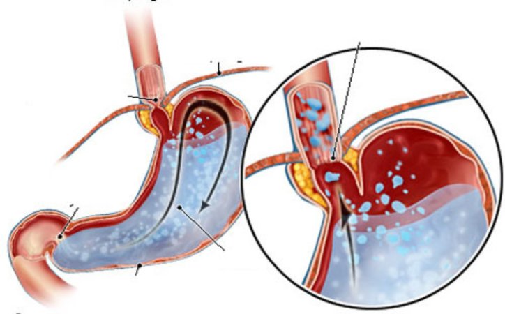 Reflüksün daimi müalicəsi: laparoskopik cərrahiyyə