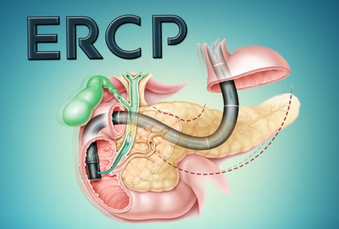 Ercp nədir, kimə tətbiq olunur?