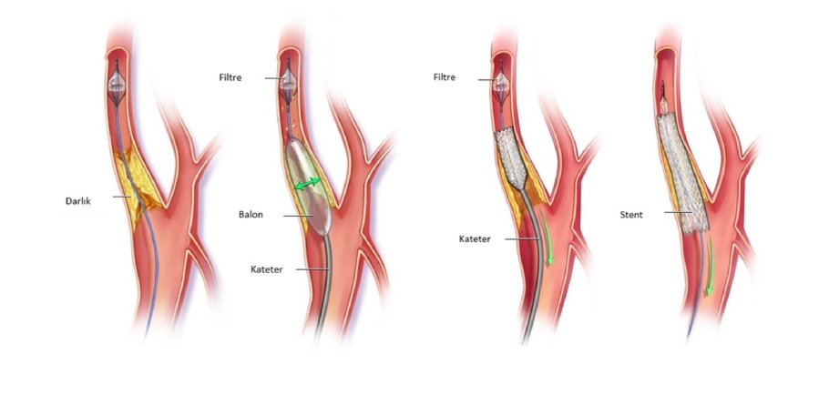 Karotid stenozu: tərif, səbəbləri və müalicə yolları