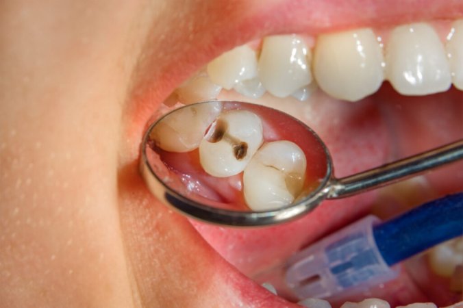 Diş çürükləri (dental karies): səbəbləri, simptomları və müalicə yolları