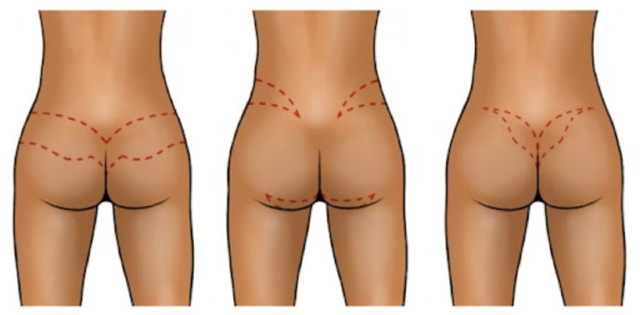 Popo kiçildilməsi (gluteoplastika): estetik və tibbi səbəblər