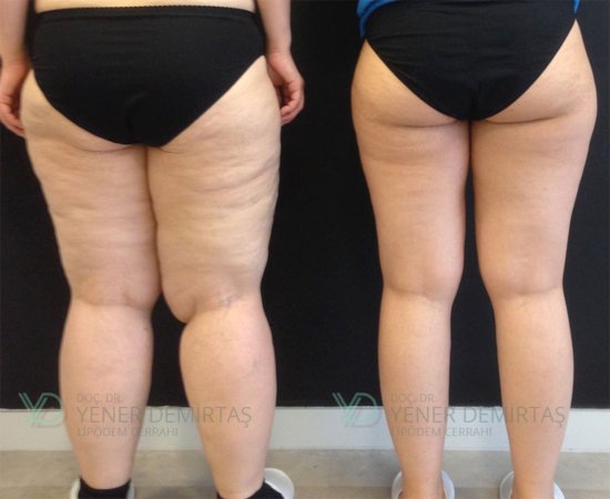 Lipödem (lipedema) tedavisi