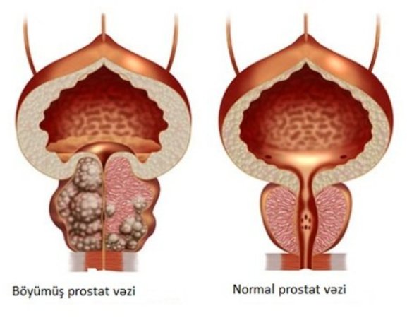 Prostat biopsiyası necə olmalıdır?