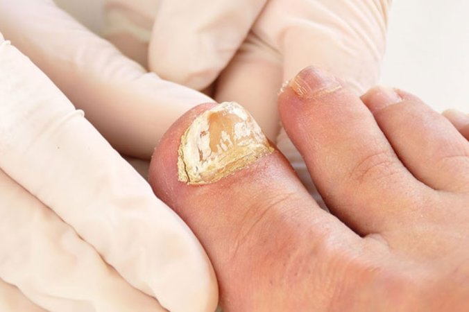 Mantar dırnaq infeksiyası: səbəbləri, müalicəsi, qarşısının alınması üsulları və tez-tez verilən suallar