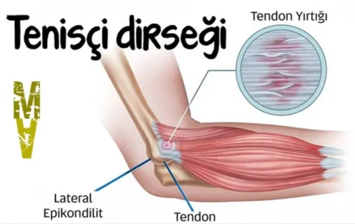 Tennis dirsəyi və müalicəsi