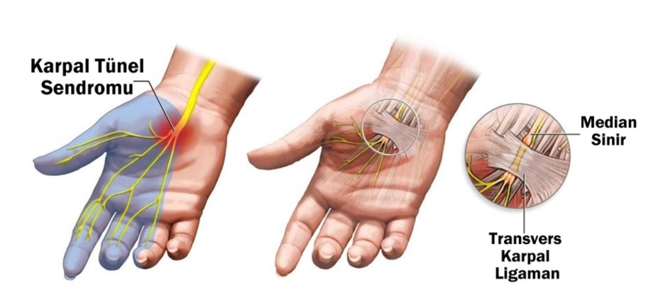 Karpal tunel sindromu nədir?