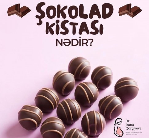 Şokolad kisti nədir?