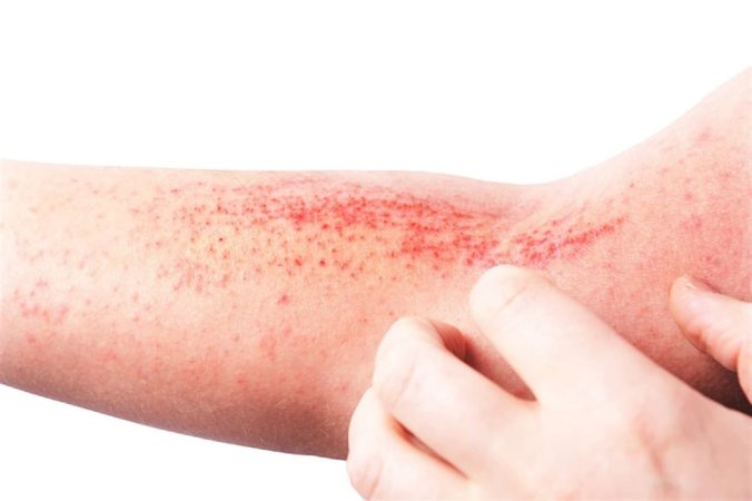 Atopik dermatit