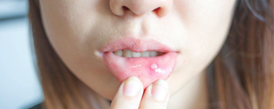 Dodaq, dil və ağız boşluğu xəstəlikləri (xərçəng yaraları, herpes və ağızdakı digər xəstəliklər)
