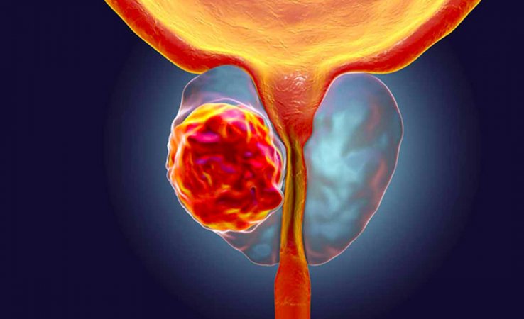 Prostat xərçəngi necə müalicə edilməlidir?