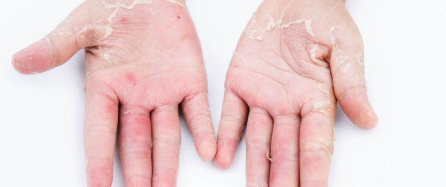 Kontakt dermatit: dəriyə təmasın nəticələri