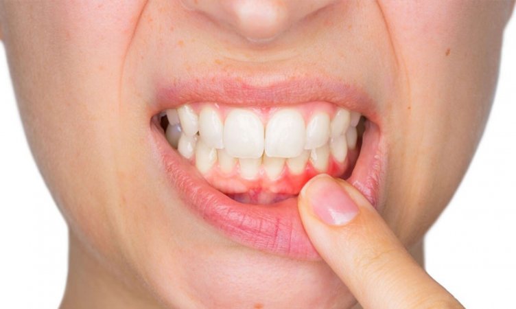 Diş əti iltihabı: müalicə, səbəblər və profilaktik tədbirlər