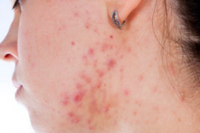Dermatoz