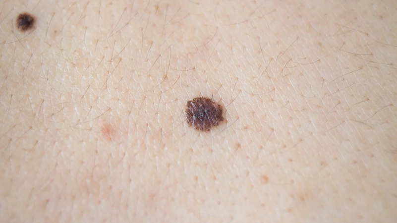 Melanoma