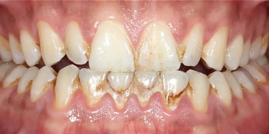 Diş Əti xəstəlikləri: gingivit və periodontitdən qorunma yolları