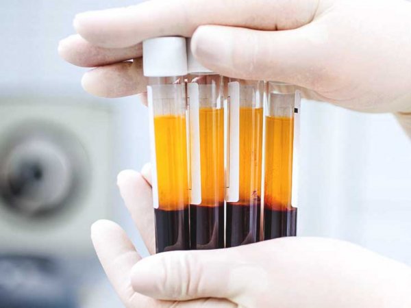 Prp (platelet rich plasma - trombositden zəngin plazma) nədir?