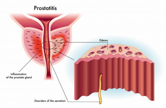 Prostatit: prostat vəzinin iltihabı
