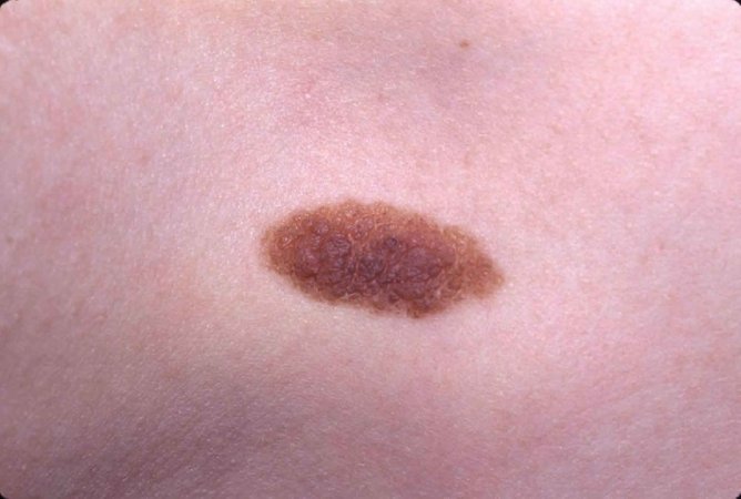 Nevus (xal)