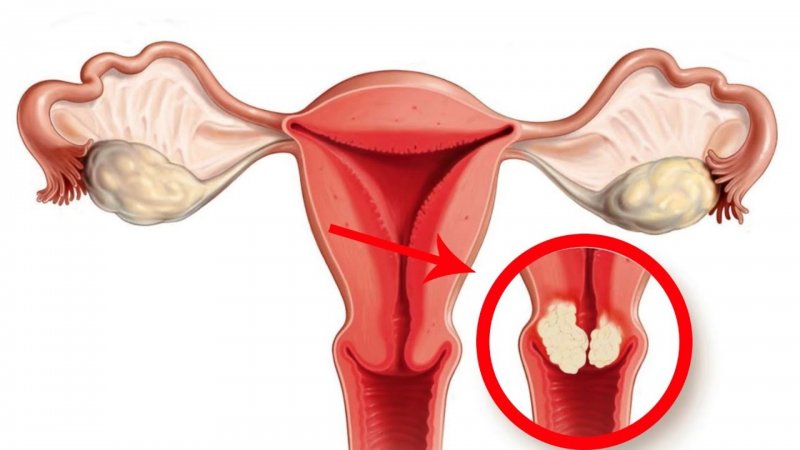 Rahim ağzı kanseri ıle ılgili bilmeniz gereken 8 gerçek!