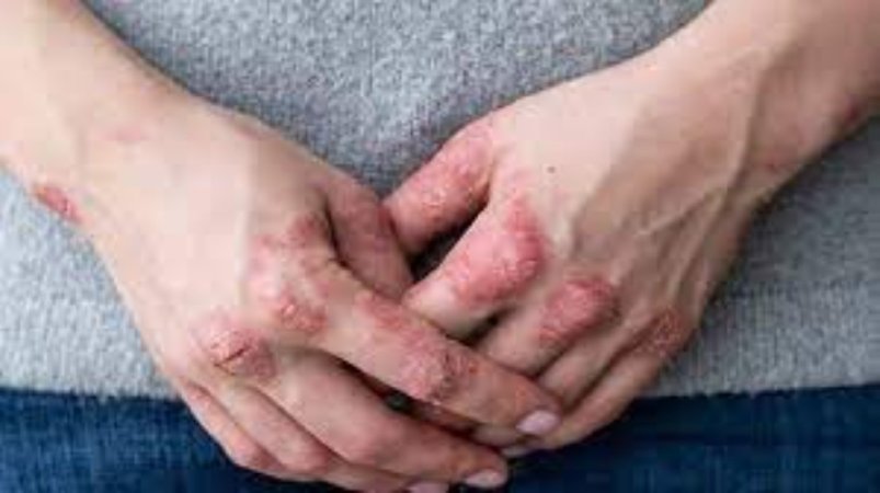 Psoriatik artrit