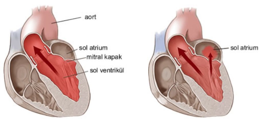Mitral qapaq xəstəliyi: ürəyin kritik komponentlərindən birində problemlər