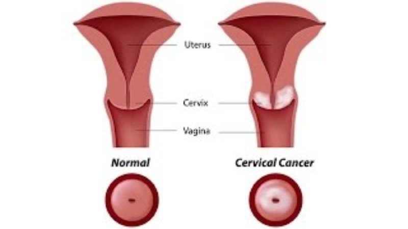 Uşaqlıq boynunda iltihabi proses (servisit)