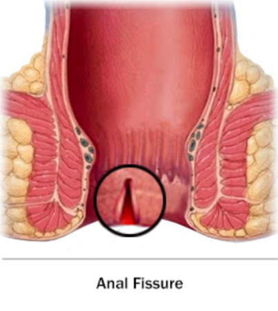Anal çat