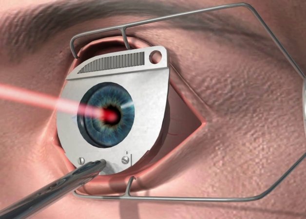 Lasik nədir, necə hazırlanır?