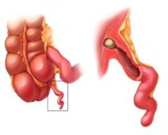 Uşaqlarda kəskin appendisit (apensit)