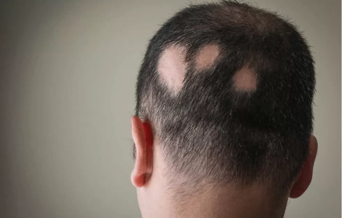 Alopesiyalar (saç tökülməsi)