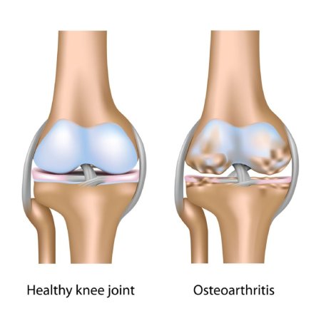 Osteoartrit və omba protezləri