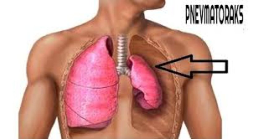 Pnevmotoraks