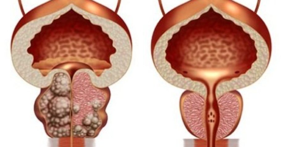 Prostat biopsiyası necə olmalıdır? Onlayn görüş