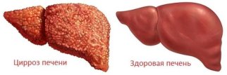 Qaraciyər xəstəlikləri (hepatit, siroz)