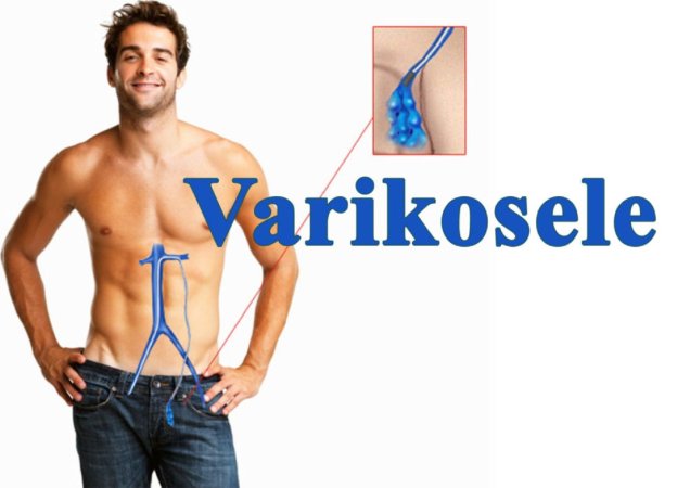 Varikosele haqqında