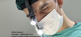 Sinusitin göz yuvasına yayılması (Orbital abse).Sinuzitin fesadlaşması LOR- Uzman.Dr.Ali Aliyev